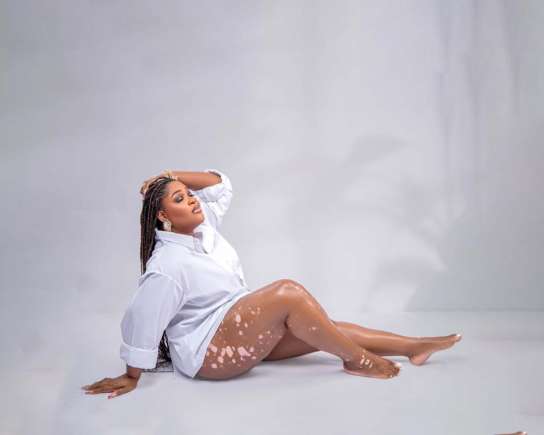 Woman with vitiligo in an oversized white shirt